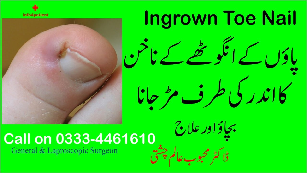 Ingrown Toenail  | Dr. Mahmoob Alam Chishti