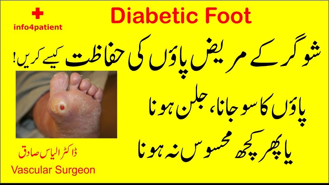 Diabetic Foot: Symptoms, Treatment & Care: Dr. Illyas Sadiq