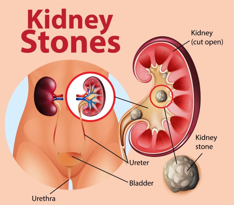 kidney stones